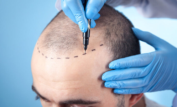 Hair transplant procedure