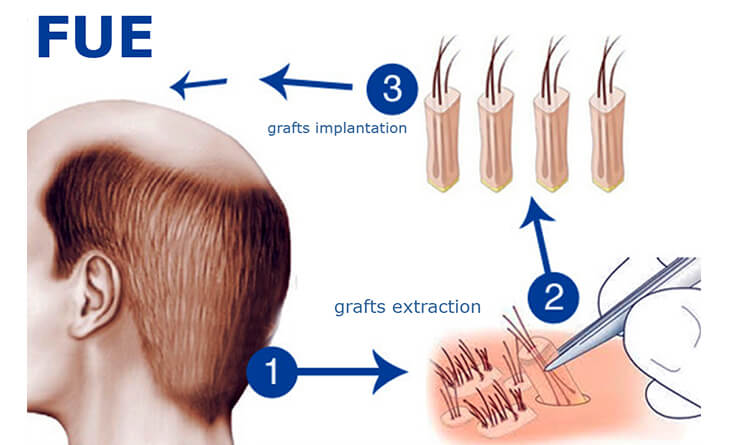 Hair transplant procedure