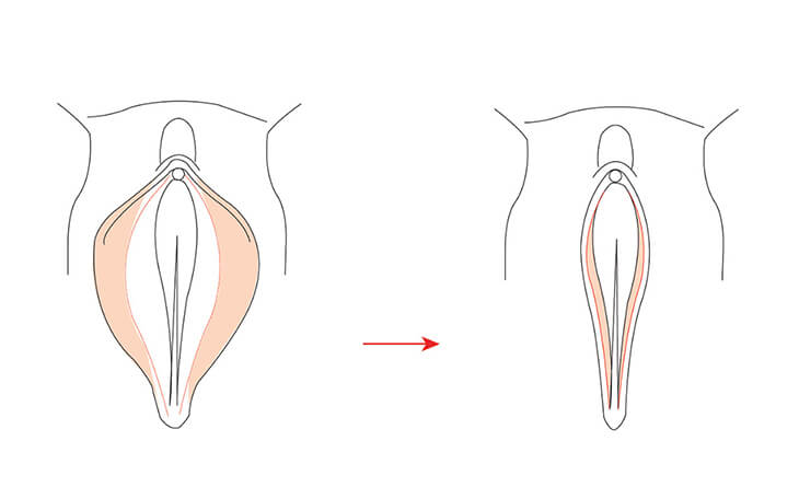 Vaginal Tightening Procedure