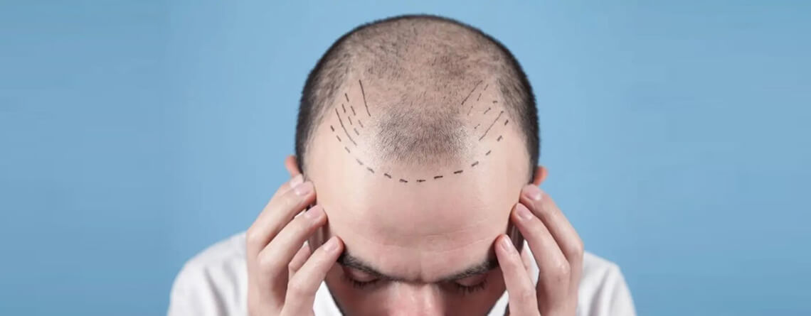 Hair Transplant in Delhi  Best Hair Transplant Clinic in Delhi  India