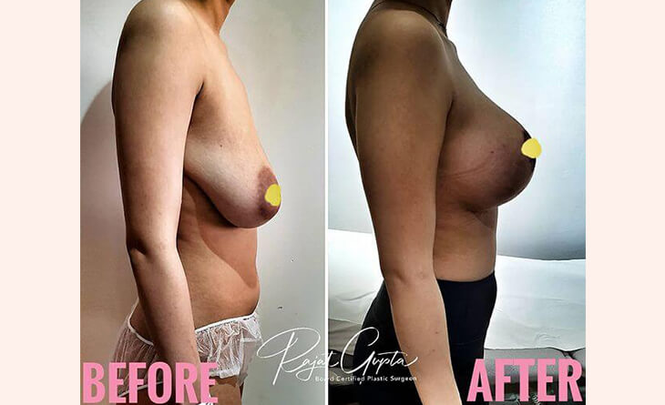 breast lift before after results