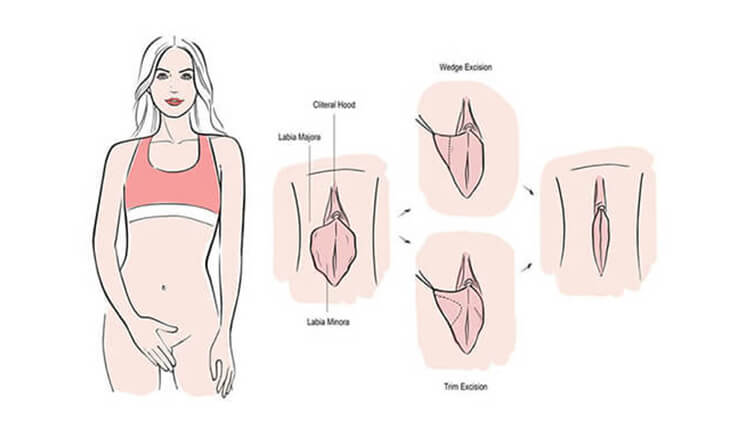 Vaginal Rejuvenation Explained - What it Does & How it Works