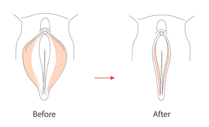 Vaginal Tightening Procedure