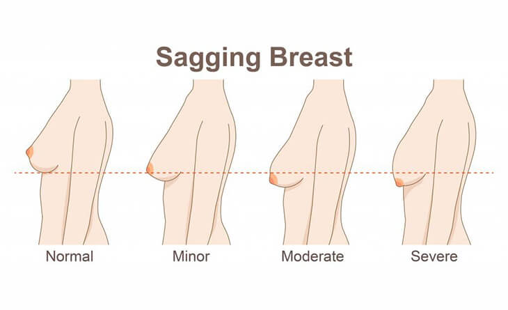 Breast Lift Procedure
