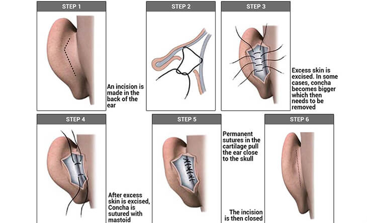 Otoplasty Surgery in Delhi