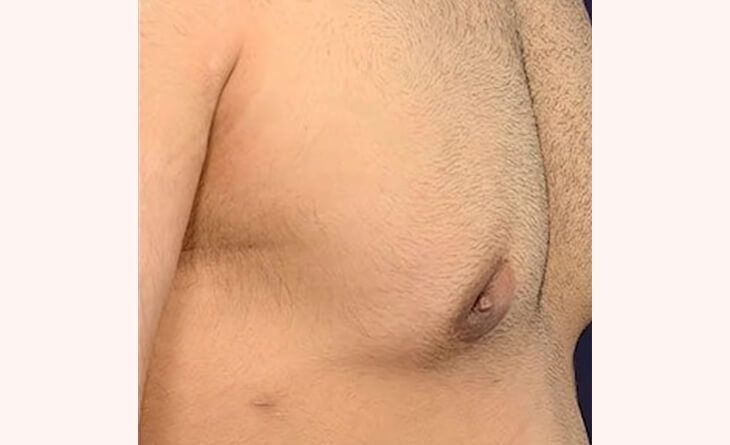 gynecomastia procedure in Delhi