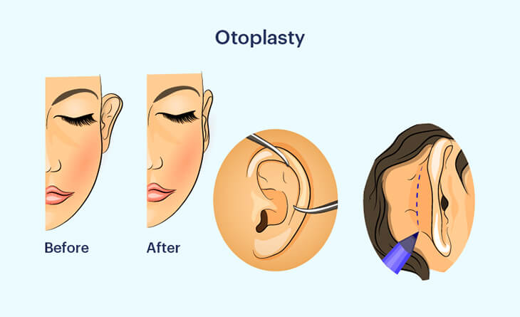 Otoplasty In Delhi