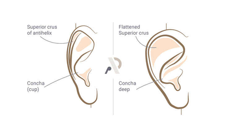 Otoplasty In Delhi