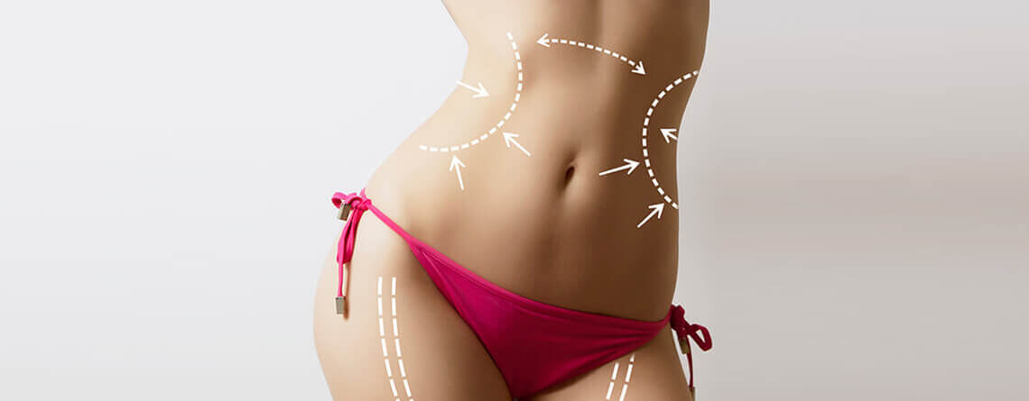 Liposuction procedure in Delhi