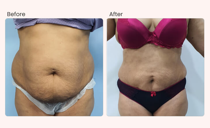 Liposuction procedure in Delhi