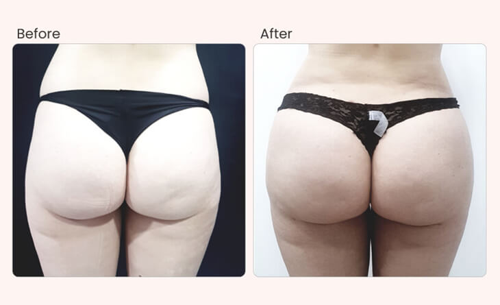 What Body Areas Can be Treated by Liposuction? Dr Rajat Gupta