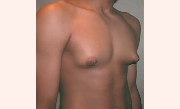 teenage gynecomastia