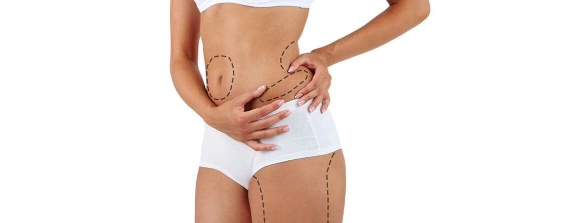 Liposuction