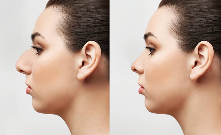 Rhinoplasty Surgery