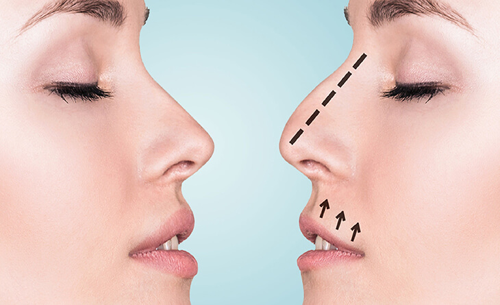 Rhinoplasty Surgery