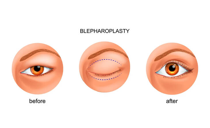 Blepharoplasty Surgery