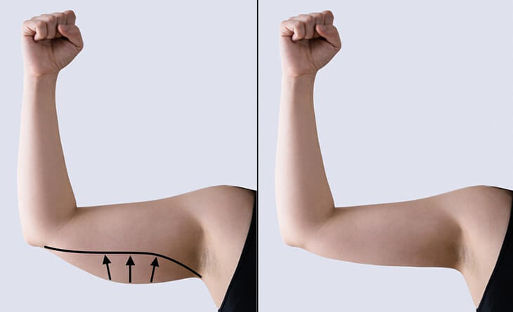 Arm Liposuction Surgery