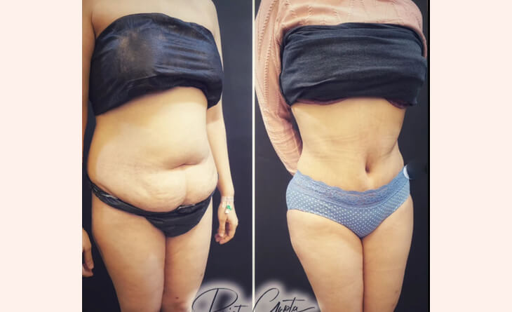 abdominoplasty