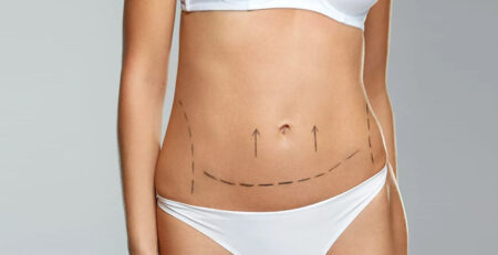 abdominoplasty