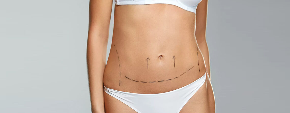 abdominoplasty