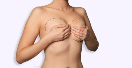 Breast Lift Surgery