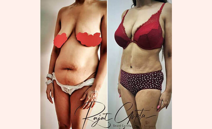 liposuction surgery