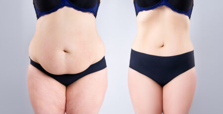 Tummy Tuck Surgery