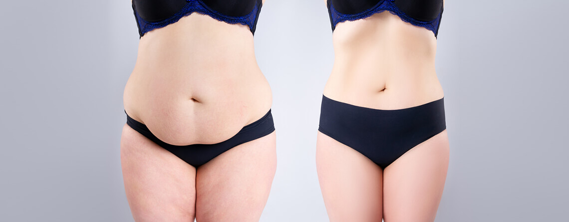 Tummy Tuck Surgery