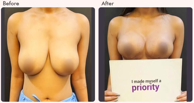 Breast Augmentation Before after result - Dr Rajat Gupta - RG Aesthetics -01