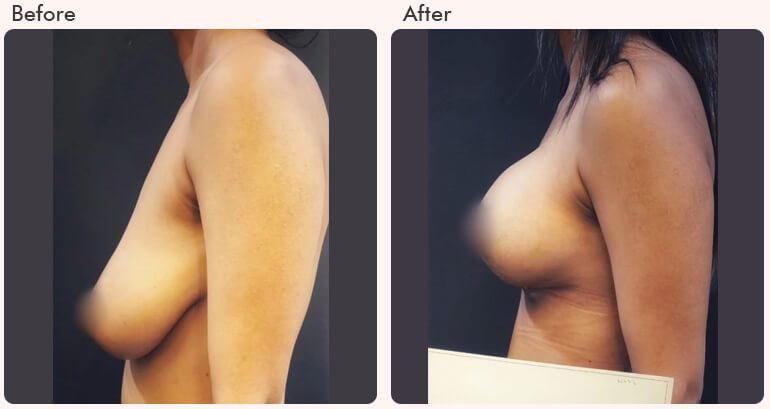 Breast Augmentation Before after result - Dr Rajat Gupta - RG Aesthetics -02