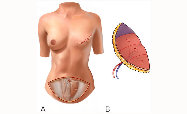 Breast Reconstruction Surgery