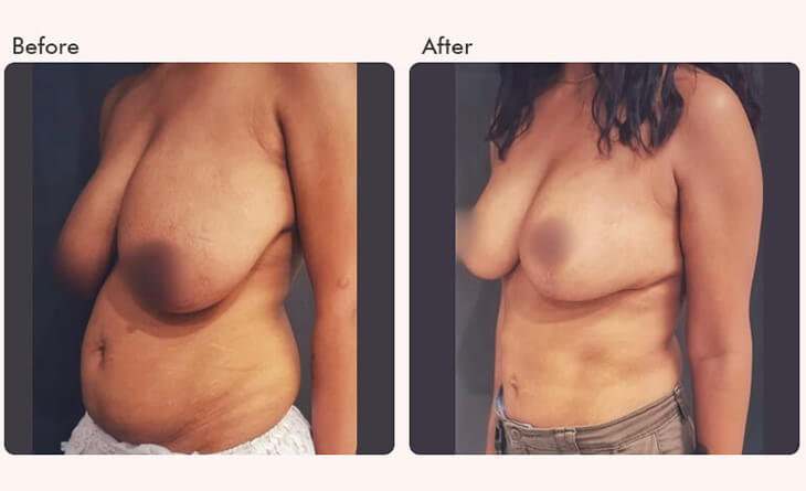 Breast reduction surgery