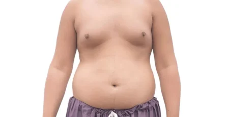 gynecomastia surgery procedure