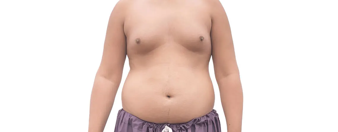 gynecomastia surgery procedure