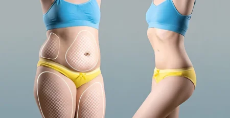 Tummy Tuck Surgery