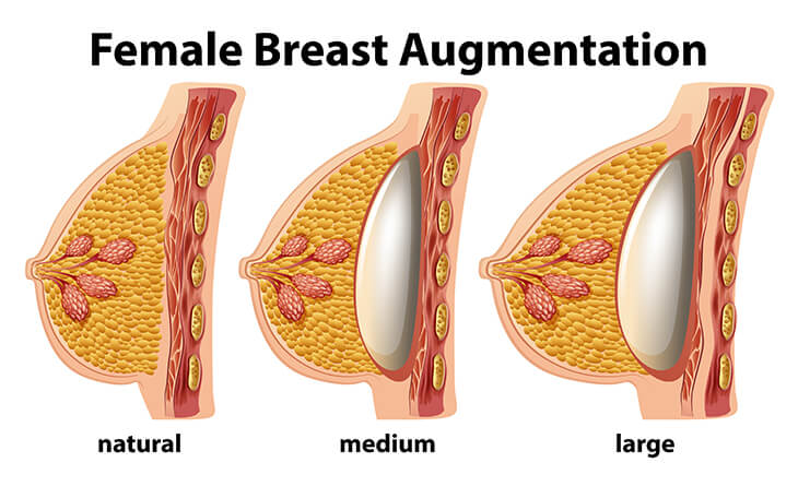 Breast Augmentation Surgery