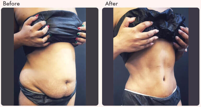 tummy tuck surgery