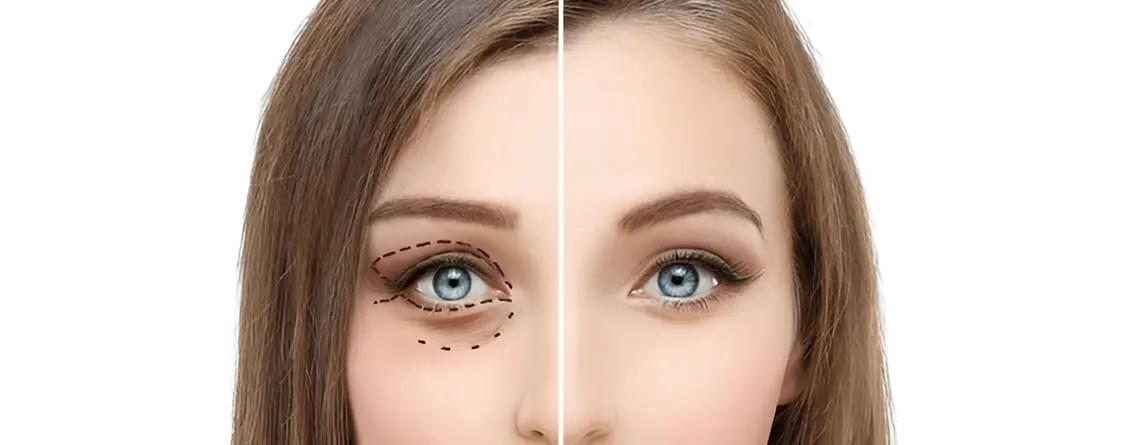 eyelid surgery