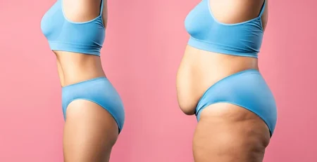 tummy tuck surgery