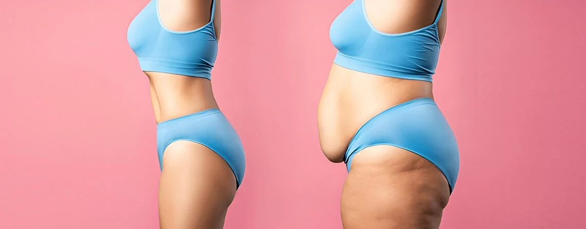 tummy tuck surgery