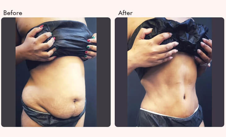 tummy tuck surgery before and after