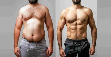 Gynecomastia Surgery