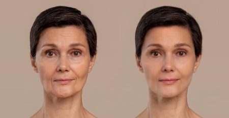 Facelift surgery