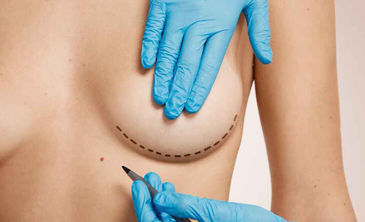 Breast reconstruction surgery