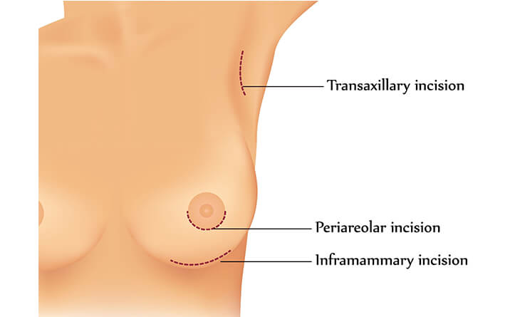 breast augmentation surgery