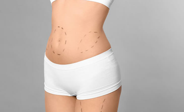 High-Definition Liposuction