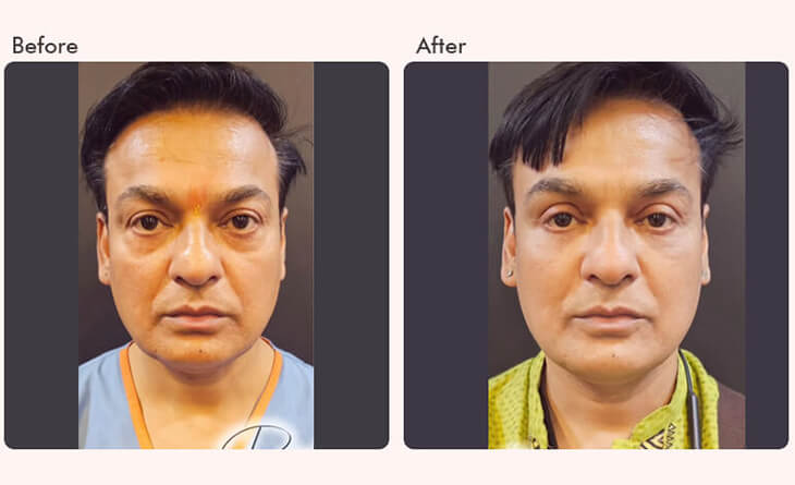 blepharoplasty surgery before and after
