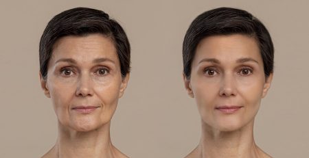 Facial Contouring Surgery