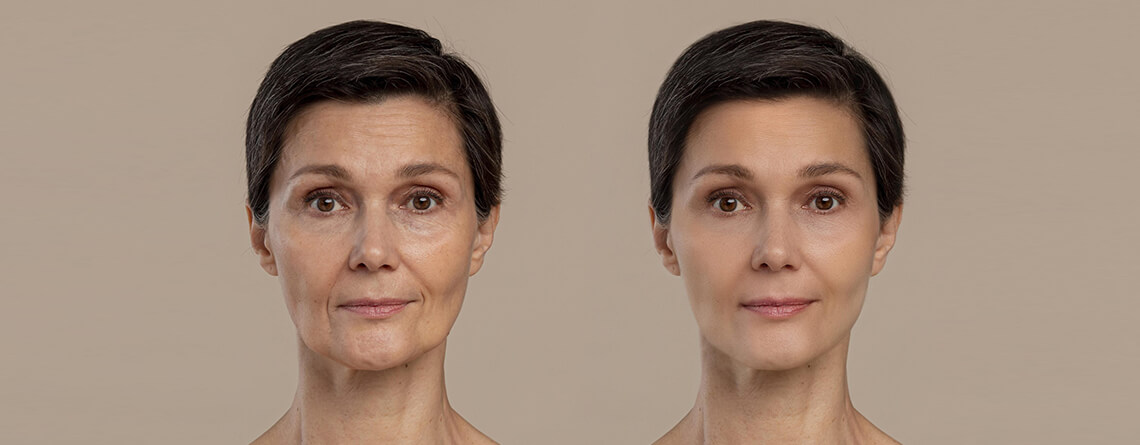 Facial Contouring Surgery