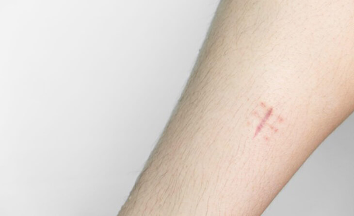 Remove Scars From Stitches